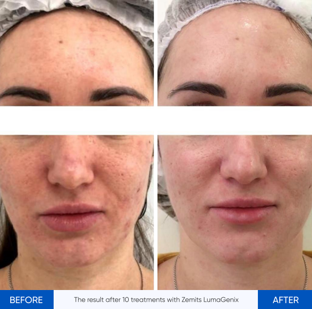 Zemits LumaGenix PDT Profesjonalne urządzenie do terapii światłem LED