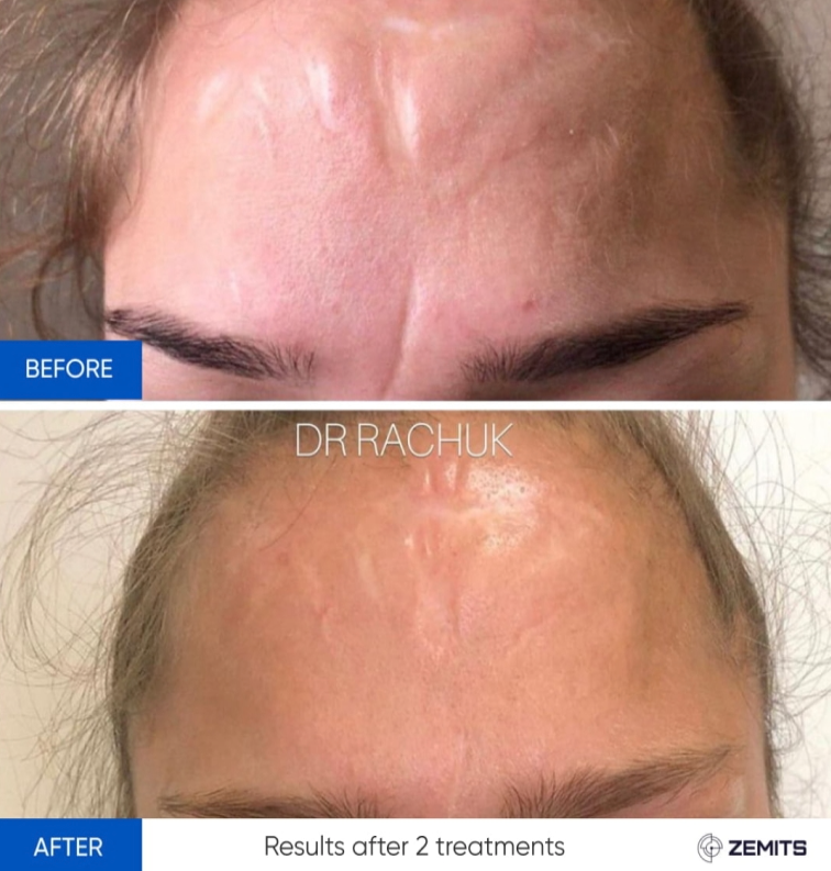 Zemits CarbonFrax Pro: Frakcyjny laser CO2