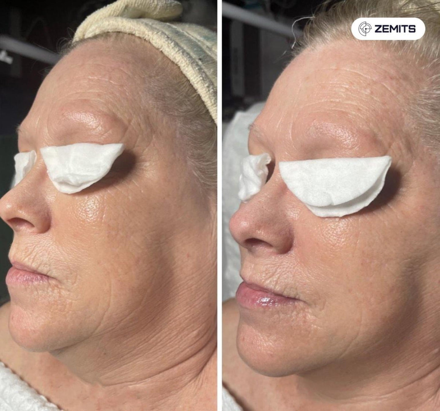 Zemits Klein EL System do elektroporacji