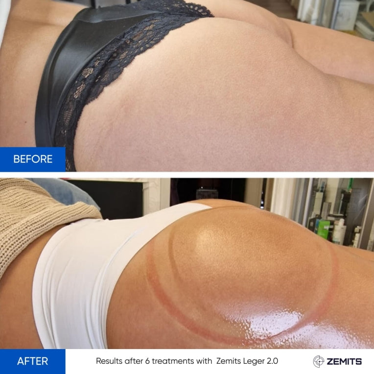 Zemits Leger 2.0 System do Masażu Próżniowego z Zestawem XXL Kubków