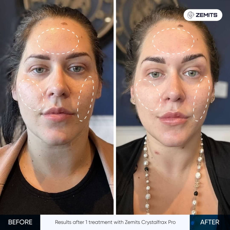Zemits CrystalFrax PRO Nieinwazyjny Frakcyjny System RF