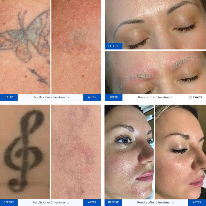 Zemits YAGenix Q-Przełączany Laser Nd:YAG